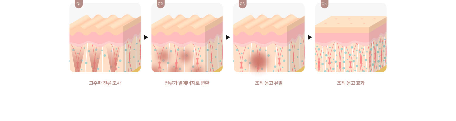 볼뉴머 시술 원리