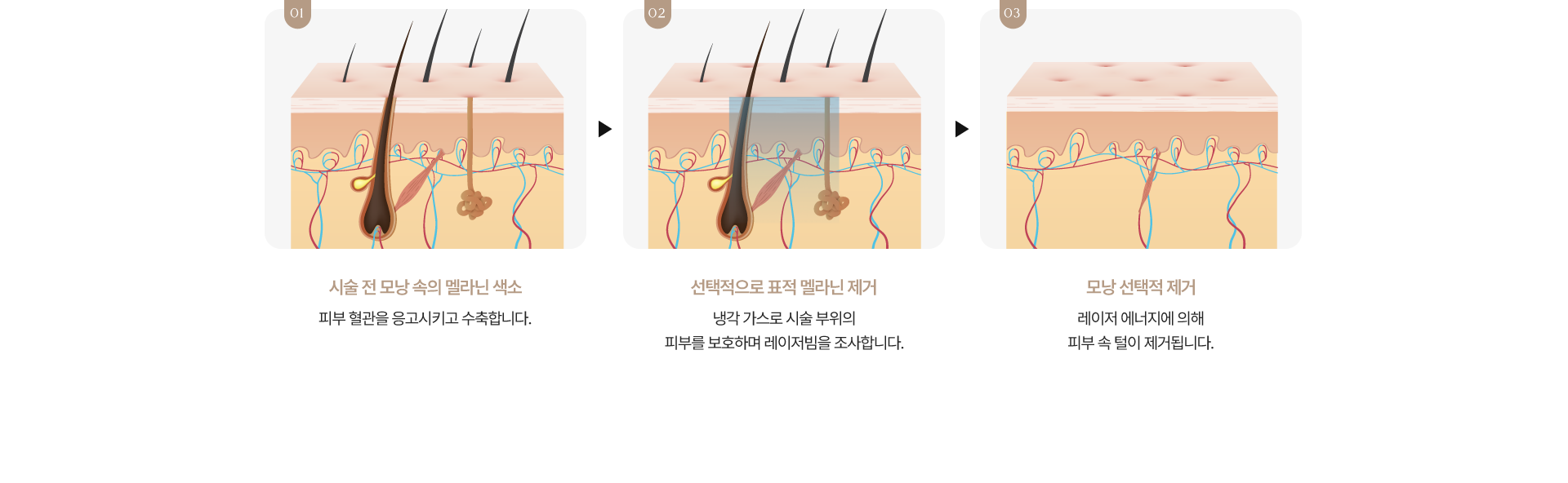 제모 시술 원리