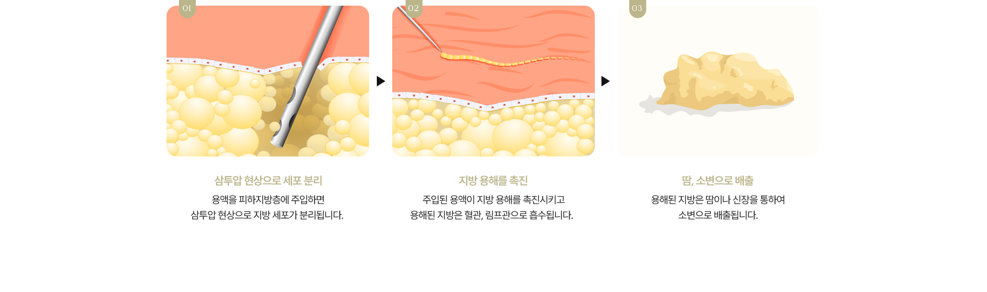 HPL 시술 원리